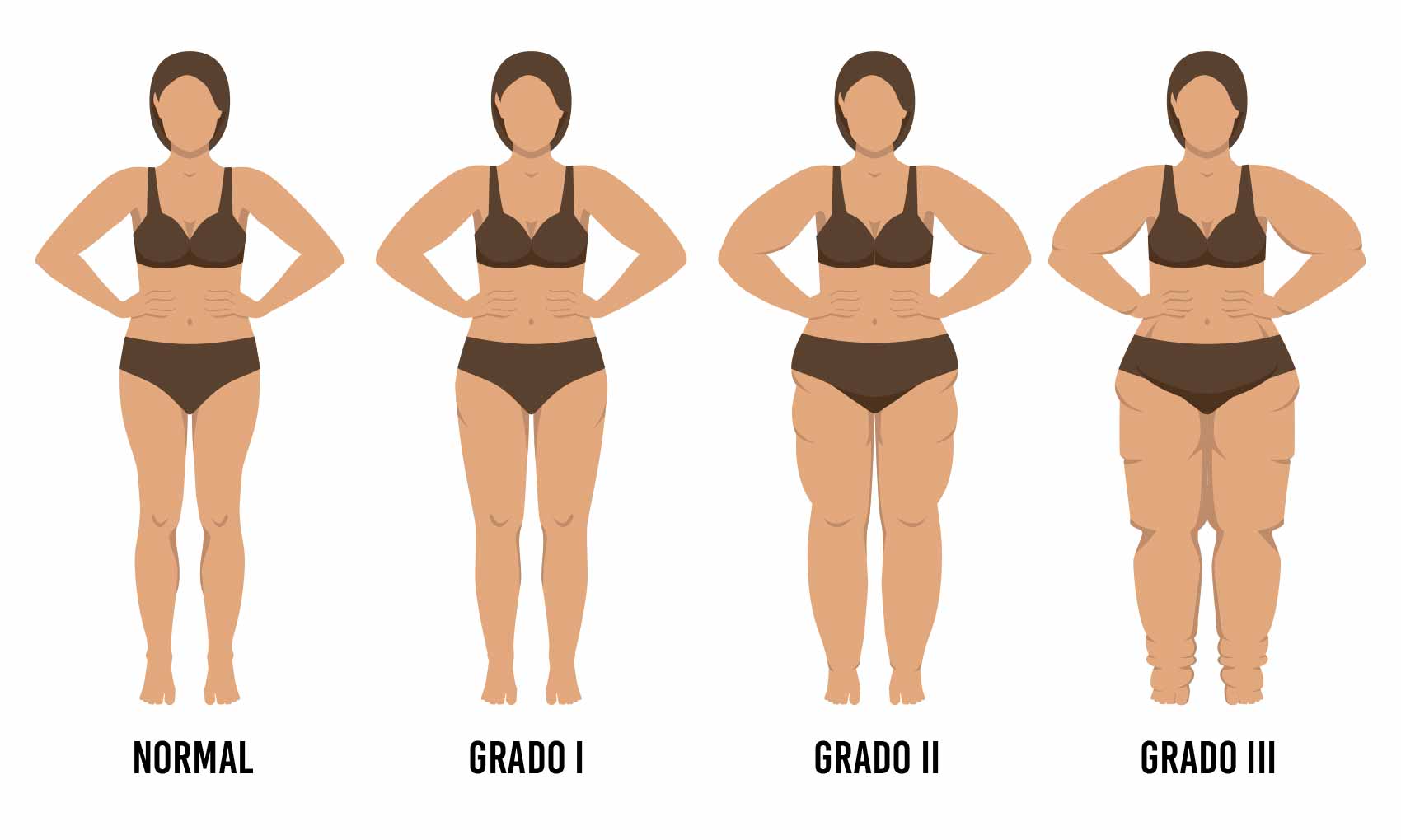 Nutrilipedema imagen